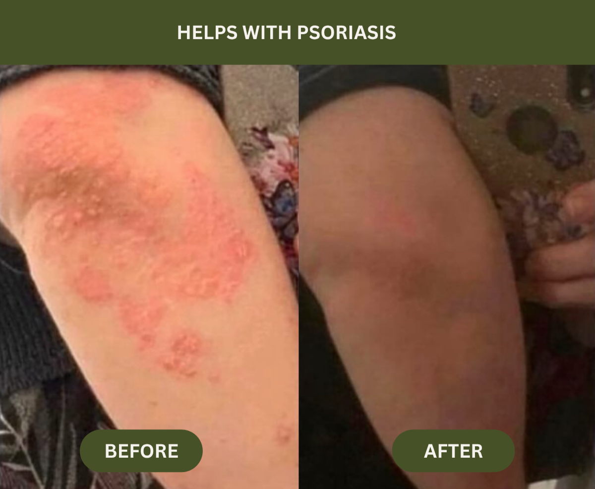Before and after comparison of psoriasis on an elbow.