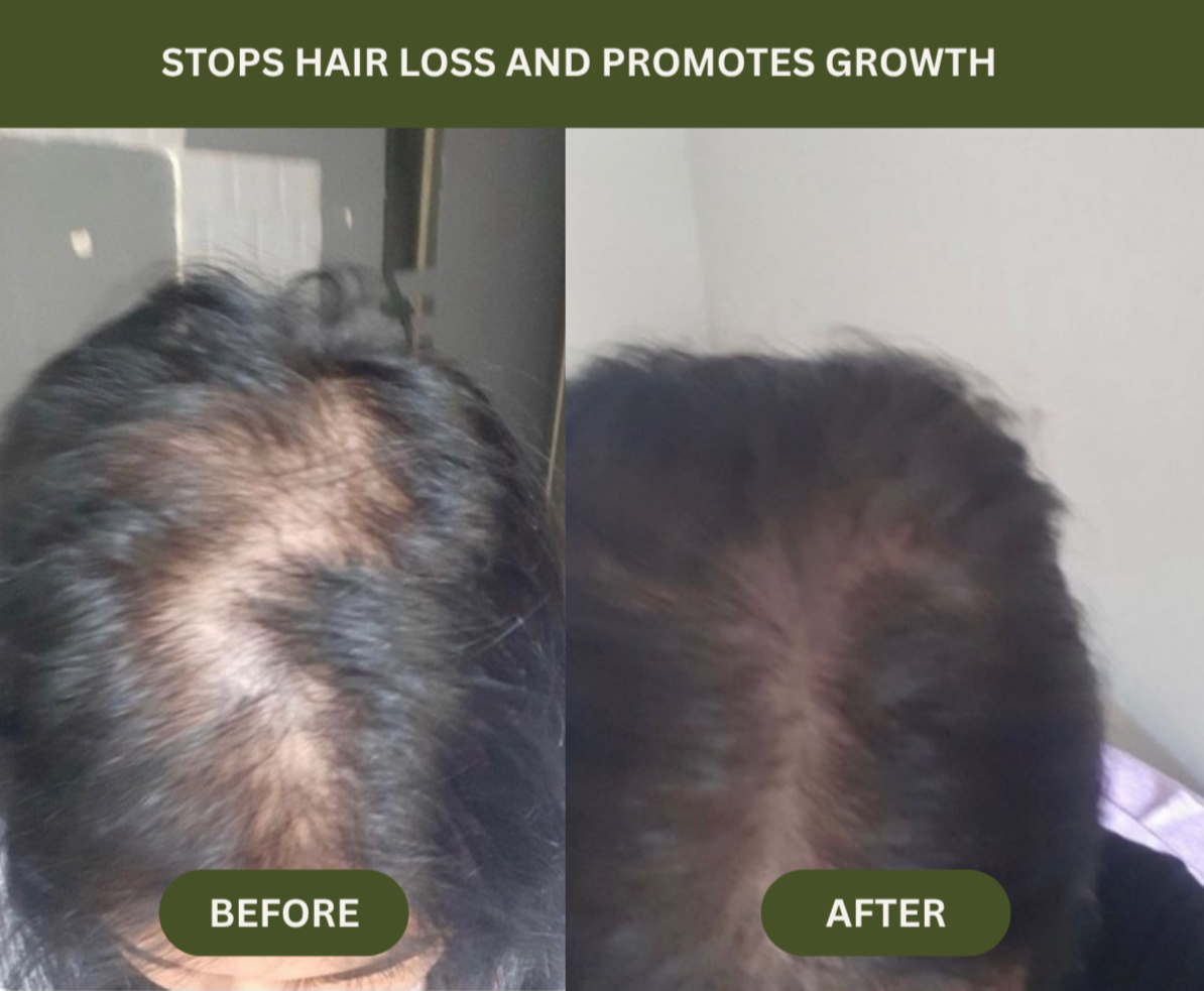 Before and after comparison of hair loss treatment on a person's head.