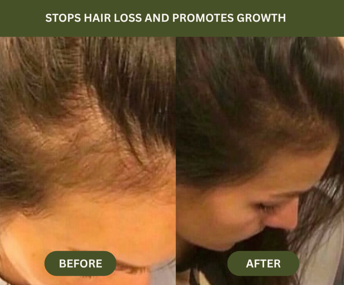 Before and after comparison of hair loss and growth treatment on a person's head.

