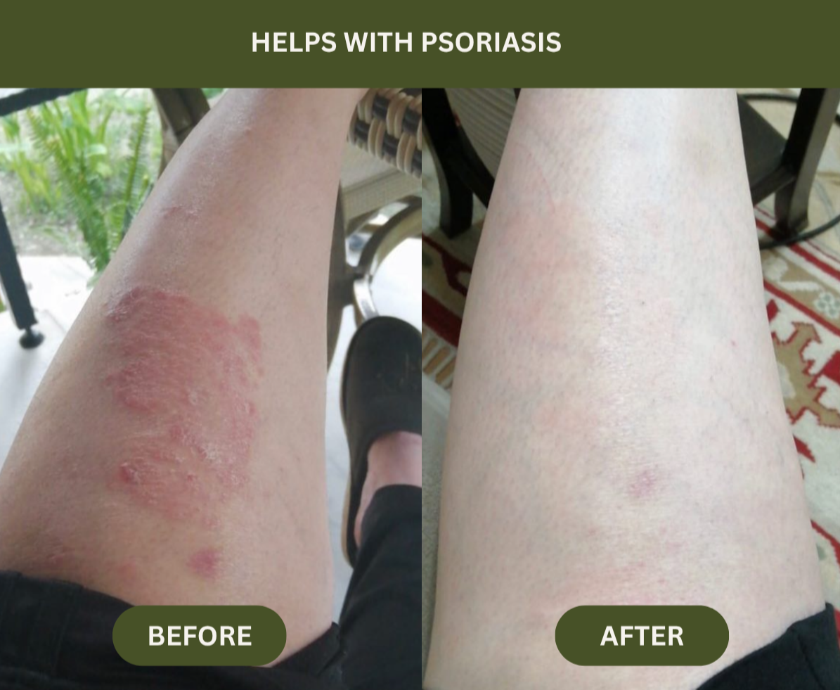 Before and after comparison of a person's leg with psoriasis treatment.

