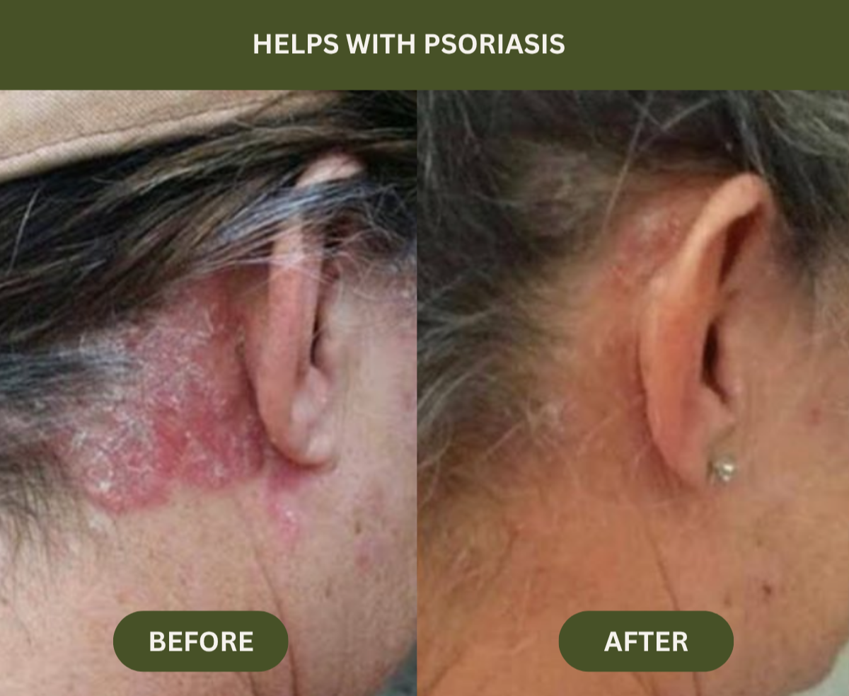 Before and after comparison of psoriasis on an ear.

